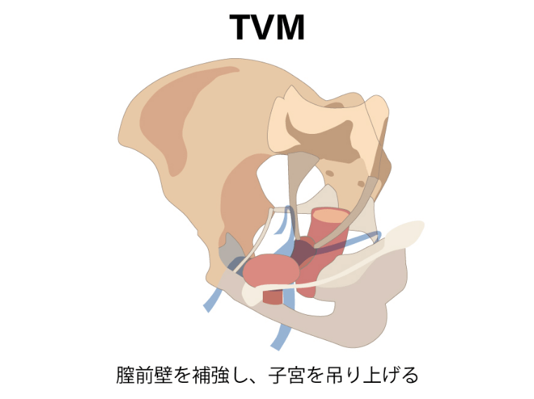 経膣メッシュ手術（TVM）のイメージ