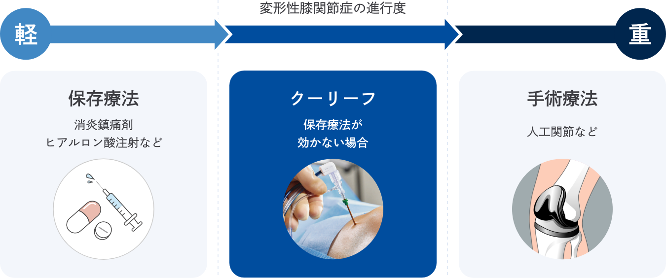 変形性膝関節症の進行度と治療選択肢
