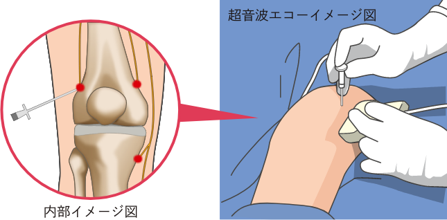 内部イメージ図と超音波エコーイメージ図